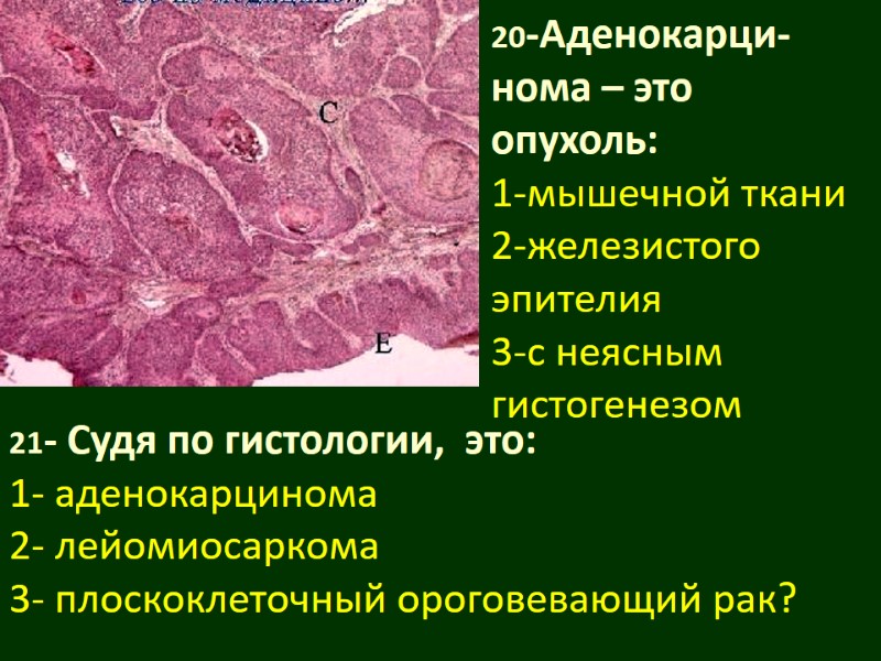 20-Аденокарци-нома – это опухоль: 1-мышечной ткани 2-железистого эпителия 3-с неясным гистогенезом  21- Судя